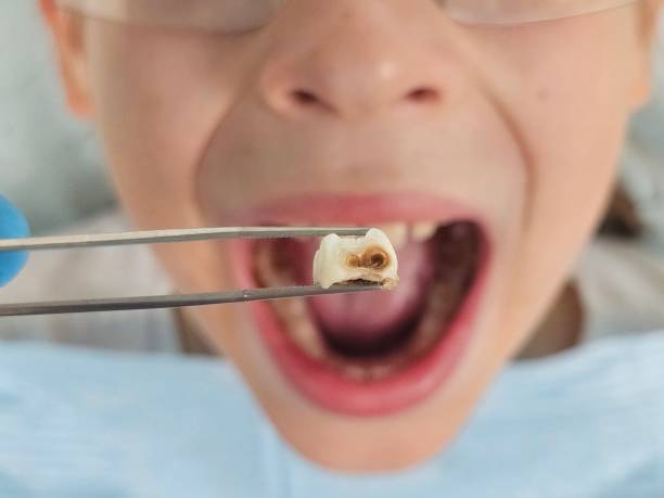 Best Emergency Dental Care for Broken or Chipped Teeth in Merced, CA
